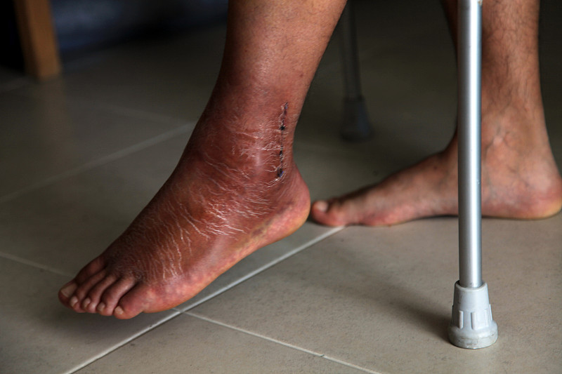 断腿,主观视角,石膏,皮肤,手,四肢,腿,疤