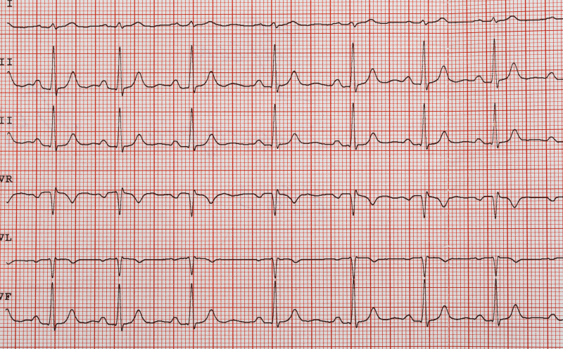 心电图,缎带,心室,脉动,心脏病专家,脉搏图,频率,图表,医药职业