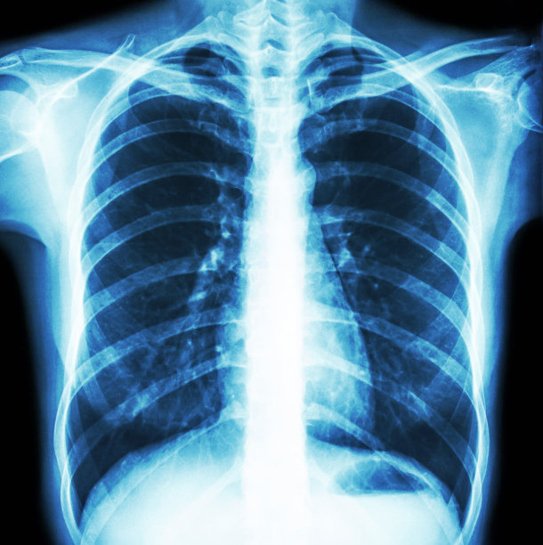 肺部x光片影像