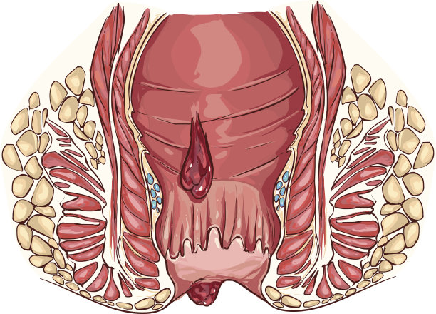 痔疮