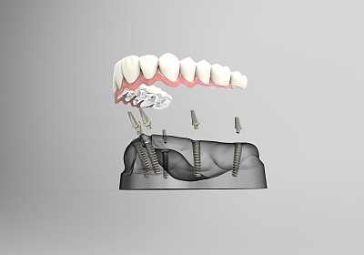 镶牙牙医