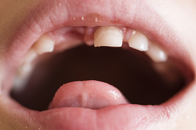 乳牙龋齿