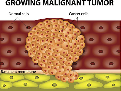 肿瘤从哪里来？