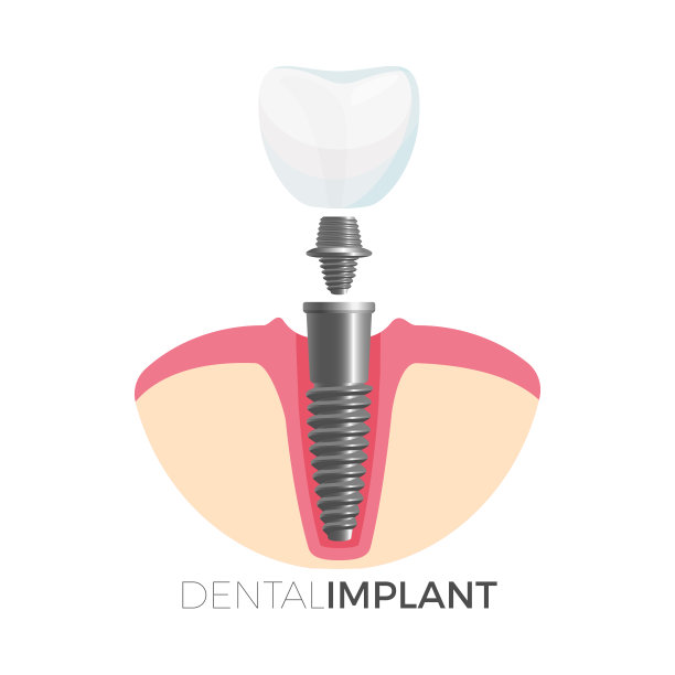 种植牙健康海报