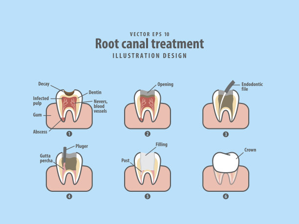 根管治疗