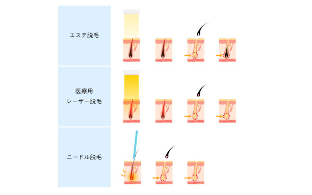 毛囊结构