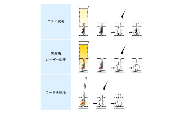 毛囊结构