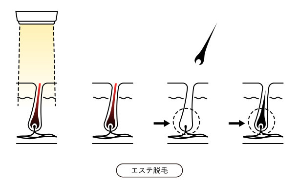 毛囊结构