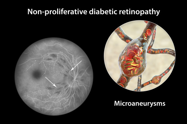 微动脉瘤