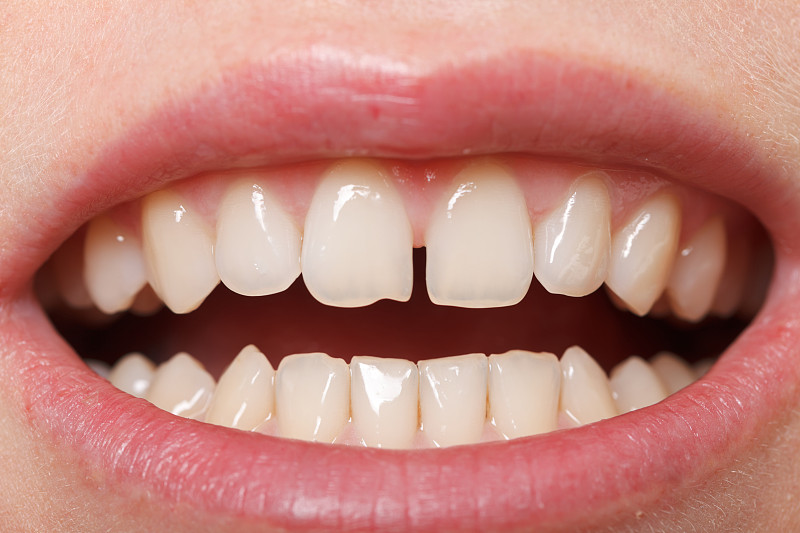 人的牙齿,在之间,顶部,缺牙,假牙,女人,水平画幅,人的嘴,健康保健,干净