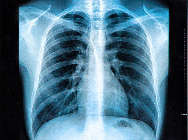 胸腔,x光,胸部,人类肺脏,人类心脏,平衡折角灯,射线成像,x光片,医学扫描仪器,放射科专家