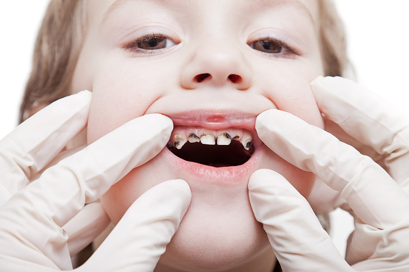 牙龈,齿龈炎,龋齿,美,水平画幅,人的嘴,牙医,白人,开着的,白色