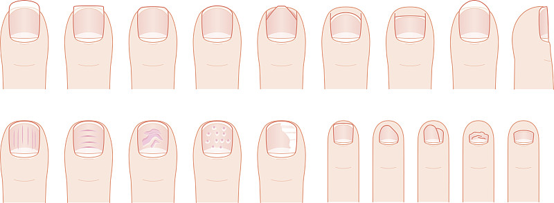 状态,手指,趾甲,形状,指甲钳,健康保健,有凹槽的,拇指,表皮