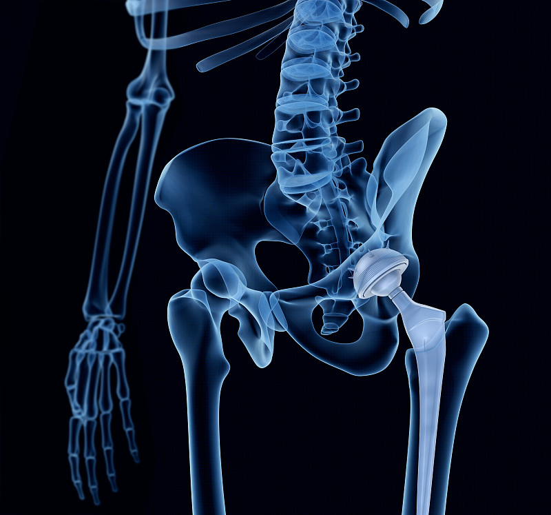 x光,骨盆,隆胸手术,骨头,人工髋关节,髋臼,整形外科,假肢,整形器具,臀