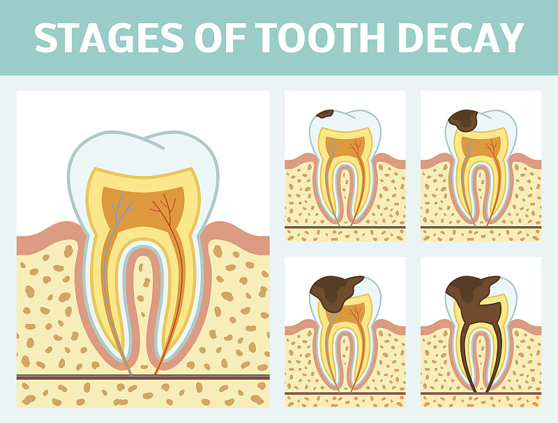 龋齿,牙本质,脓肿,牙龈,根部,牙冠,细菌,牙医,横截面,神经系统