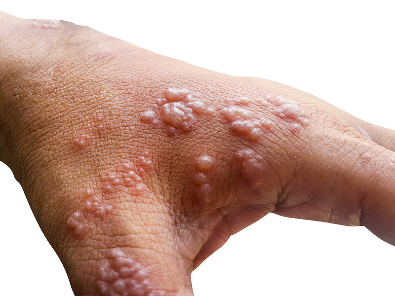 病毒,手臂,皮肤,水泡,水痘带状疱疹病毒,皮肤状况,疱疹,过敏药,症状,皮肤病学