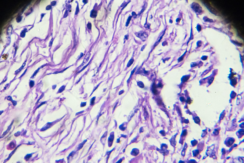 结核杆菌,人,在下面,显微镜,幻灯片,肺静脉,填隙片晶,微动脉瘤,纤维症,呼吸机