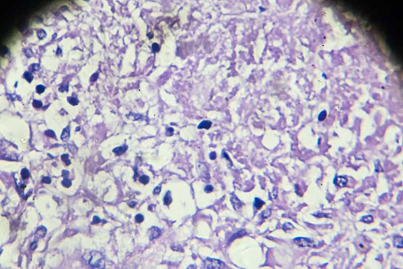 结核杆菌,人,在下面,显微镜,幻灯片,填隙片晶,微动脉瘤,肺静脉,纤维症,呼吸机
