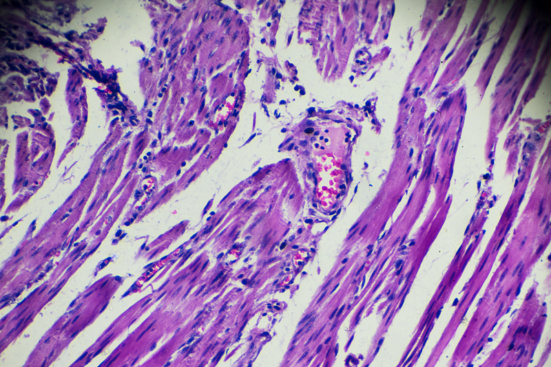 Carcinoma,of,oesophagus,(well?differentiated,squamous,disease)