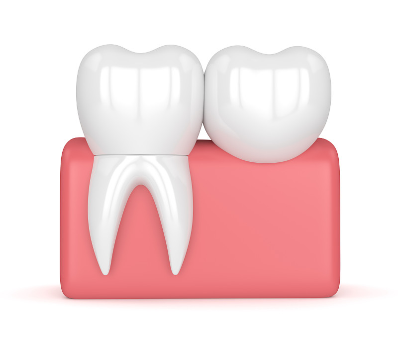 悬臂桥,三维图形,牙齿,口腔卫生,合成图像,人造的,牙冠,假牙,牙龈,水平画幅