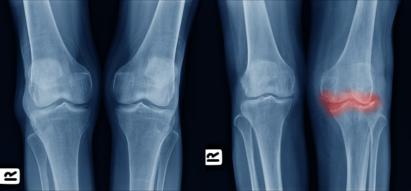 膝,骨关节炎,彩色图片,左撇子,比较,古老的,x光片,正面视角