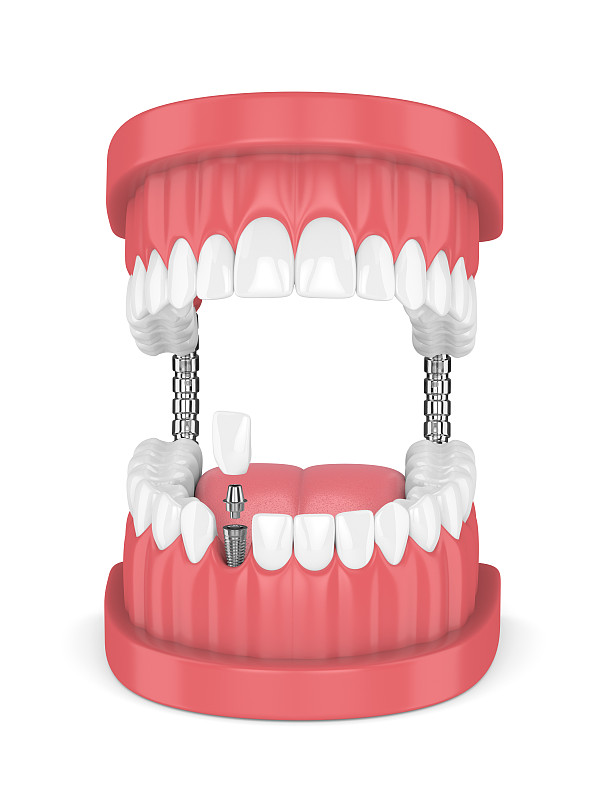 三维图形,隆胸手术,牙齿,口腔卫生,人的牙齿,垂直画幅,人造的,牙本质,牙冠,牙龈