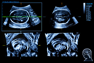 孕期超声监视器彩色图像