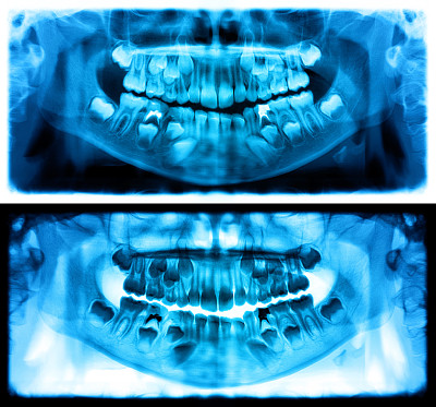 蓝色全景x光片是一种上下颌全景扫描牙科x光片。这是焦平面断层扫描显示的是一个七岁小孩的上颌骨和下颌骨。