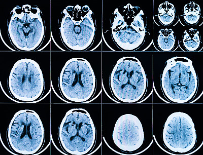 MRI扫描人类头部胶片