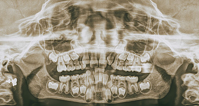 儿童义齿X光图