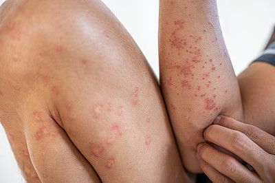 亚洲腿和手臂的特应性皮炎皮肤问题