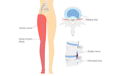 图示椎间盘突出的坐骨神经痛神经和被困的神经使病人的腿部和臀部疼痛。医学图说明。