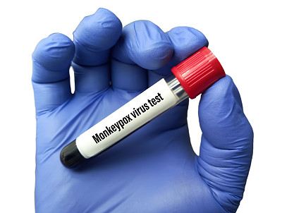 猴痘病毒检测用血样管。它也被称为Moneypox病毒，是一种双链DNA