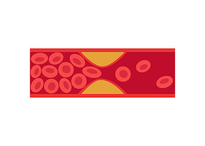 深静脉血栓形成(DVT)，含脂肪细胞的动静脉疾病，血管流动异常。胆固醇在人的血管中阻塞。矢量图