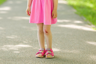 蹒跚学步的女孩与磨损的膝盖皮肤站在柏油人行道在城市公园在夏天。孩子摔倒后。特写镜头。前视图。