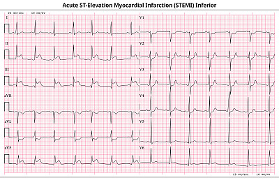心电图急性STEMI (st段抬高心肌梗死)- 12导联心电图常见病例- 6秒/导联