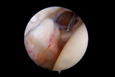 肩关节外伤后SLAP病变的关节镜修复