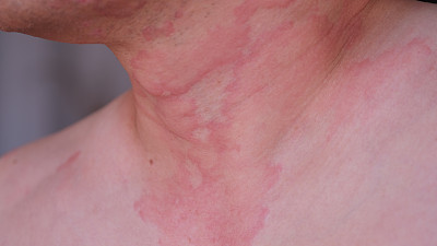 皮肤纹理的特写图像遭受严重的荨麻疹或荨麻疹或卡利塔在颈部。过敏症状。
