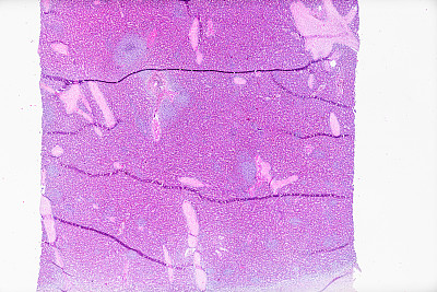 人脾中央静脉透明样变的显微镜下病理标本