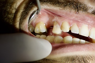 牙医椅上病人的嘴巴缺了一颗牙