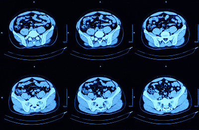 腹腔断层扫描