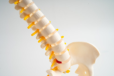 腰椎移位，椎间盘碎片突出，脊神经和骨头突出。骨科治疗医学典范。