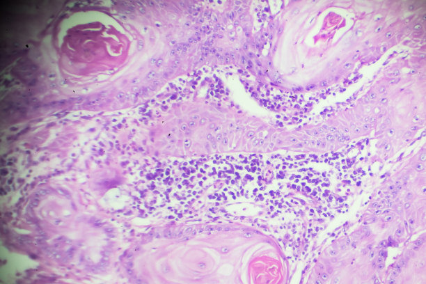 鳞状细胞癌显微镜下