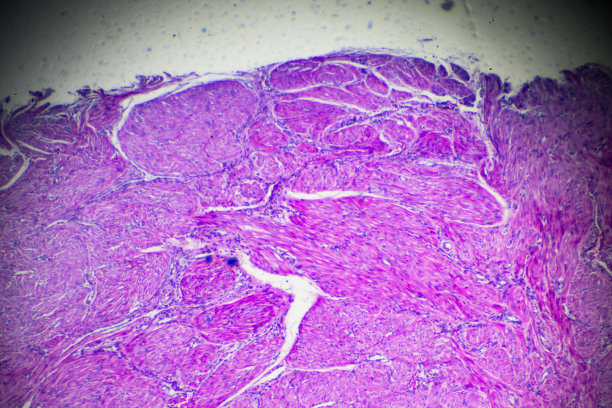 显微镜下子宫内膜癌生物样本