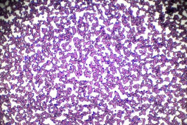 光镜下慢性淋巴细胞白血病(CLL)血液涂片