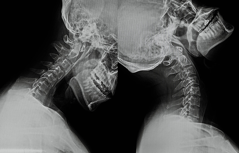 颈,x光,人的头部,骨骼,锁骨,人类骨架,脊柱,放射科专家,病人