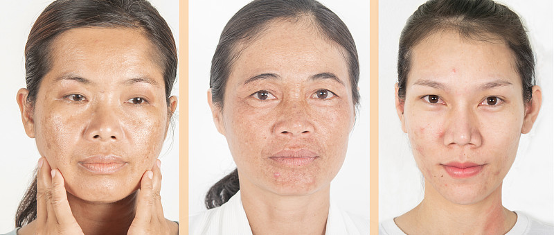人的脸部,皮肤,年龄,太阳黑子,多样,健康保健,医疗流程,皮肤病学,泰国,女人