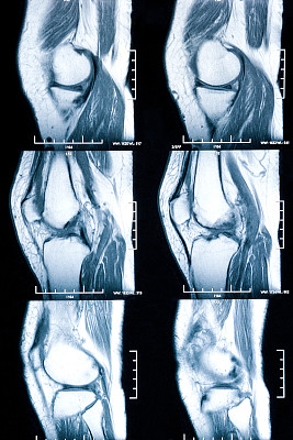 膝关节MR -交叉和半月板损伤