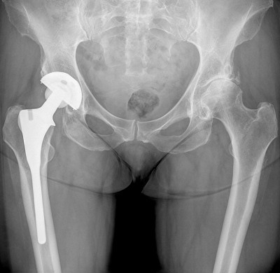 骨关节炎右侧全髋关节置换术指盆x线片