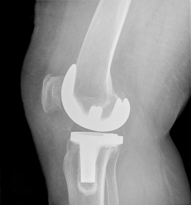 膝关节置换手术成功后的数字x光